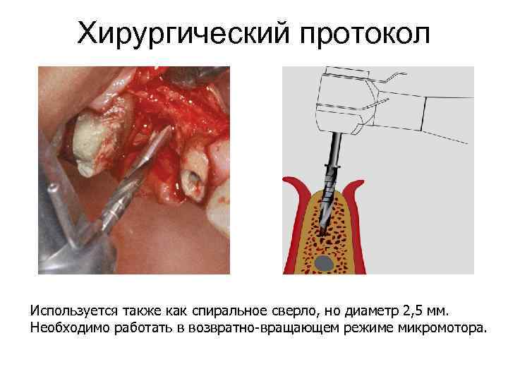 Хирургический протокол Используется также как спиральное сверло, но диаметр 2, 5 мм. Необходимо работать