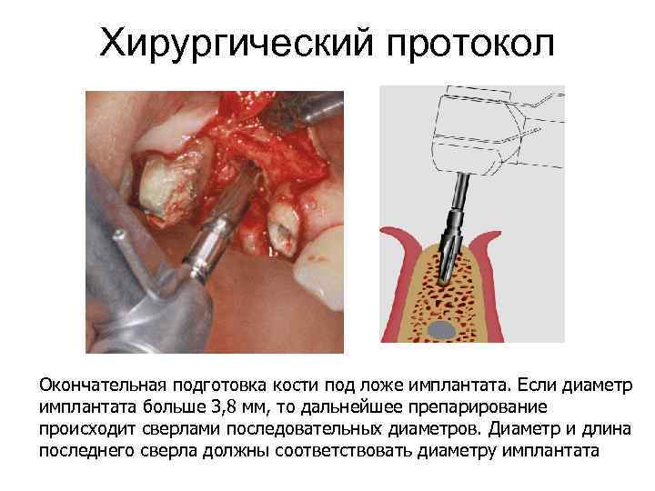 Хирургический протокол Окончательная подготовка кости под ложе имплантата. Если диаметр имплантата больше 3, 8