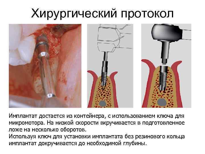 Хирургический протокол Имплантат достается из контейнера, с использованием ключа для микромотора. На низкой скорости