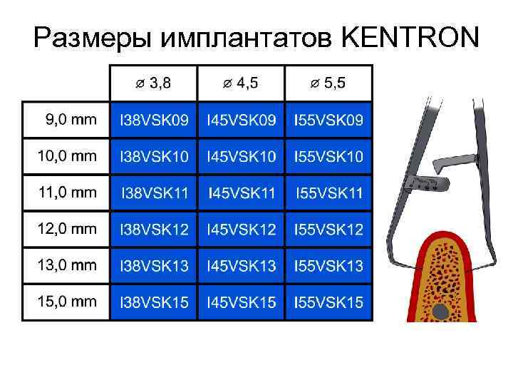 Размеры имплантатов KENTRON 