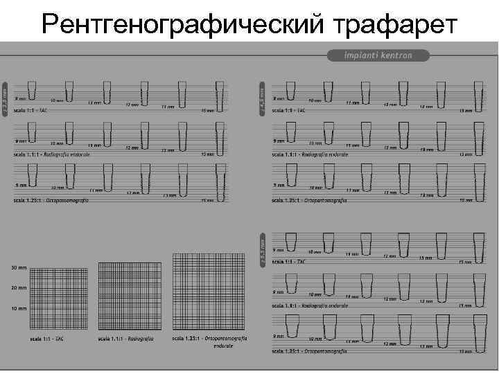 Рентгенографический трафарет 