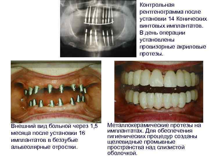 Контрольная рентгенограмма после установки 14 Конических винтовых имплантатов. В день операции установлены провизорные акриловые