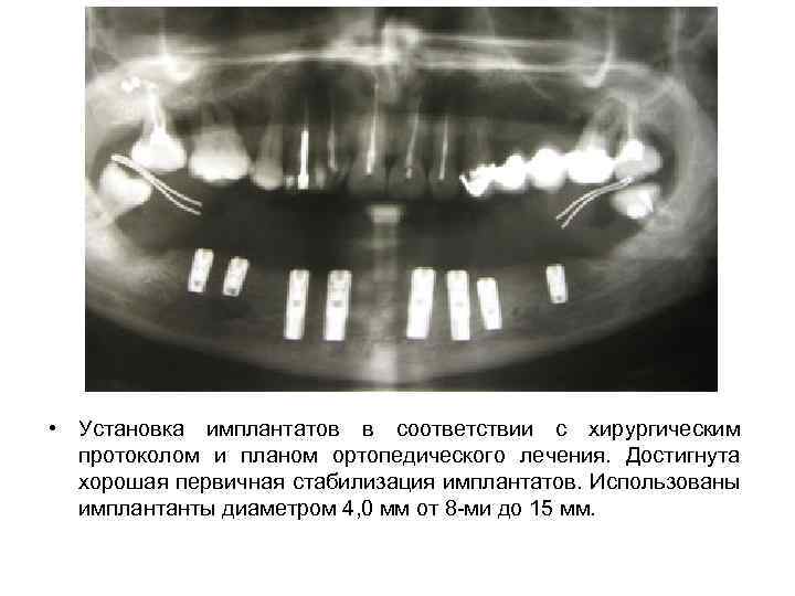  • Установка имплантатов в соответствии с хирургическим протоколом и планом ортопедического лечения. Достигнута