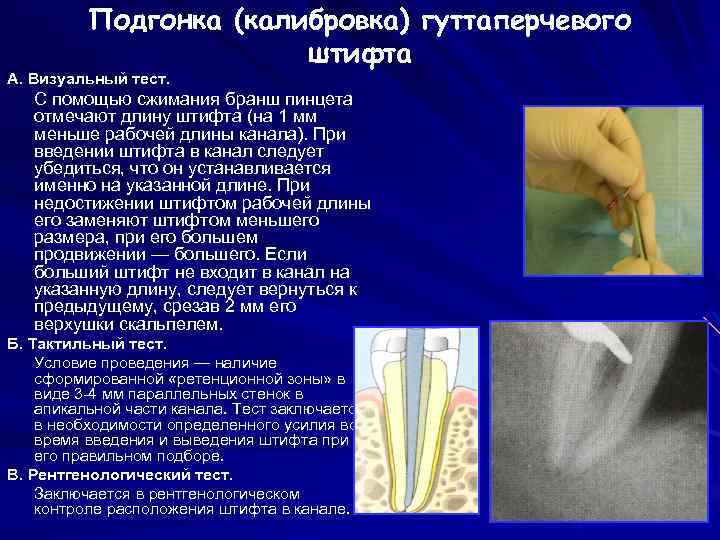 Подгонка (калибровка) гуттаперчевого штифта А. Визуальный тест. С помощью сжимания бранш пинцета отмечают длину