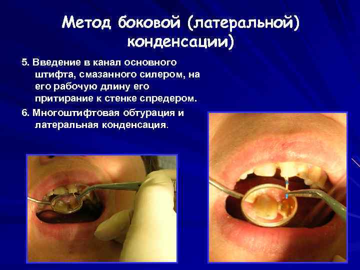 Метод боковой (латеральной) конденсации) 5. Введение в канал основного штифта, смазанного силером, на его