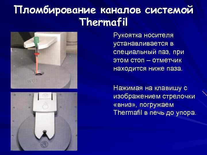 Пломбирование каналов системой Thermafil Рукоятка носителя устанавливается в специальный паз, при этом стоп –