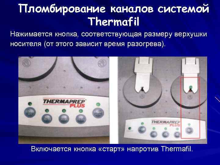 Пломбирование каналов системой Thermafil Нажимается кнопка, соответствующая размеру верхушки носителя (от этого зависит время