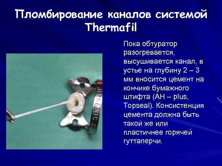 Пломбирование каналов системой Thermafil Пока обтуратор разогревается, высушивается канал, в устье на глубину 2
