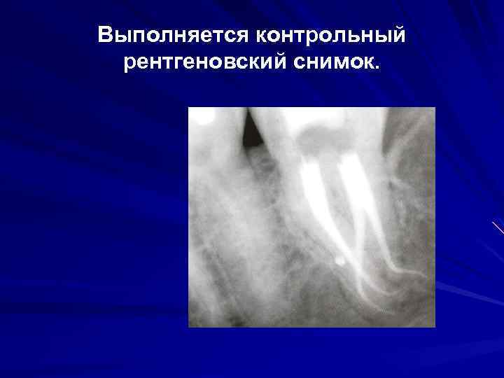 Выполняется контрольный рентгеновский снимок. 