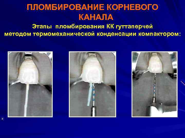 ПЛОМБИРОВАНИЕ КОРНЕВОГО КАНАЛА Этапы пломбирования КК гуттаперчей методом термомеханической конденсации компактором: Р 