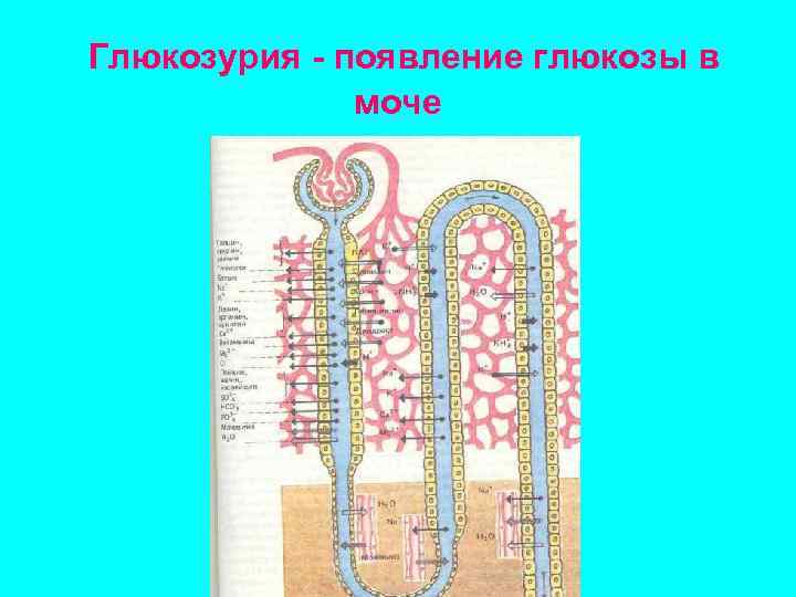 Глюкозурия - появление глюкозы в моче 