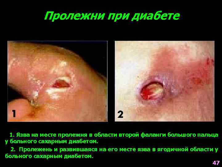 Пролежни при диабете 1. Язва на месте пролежня в области второй фаланги большого пальца