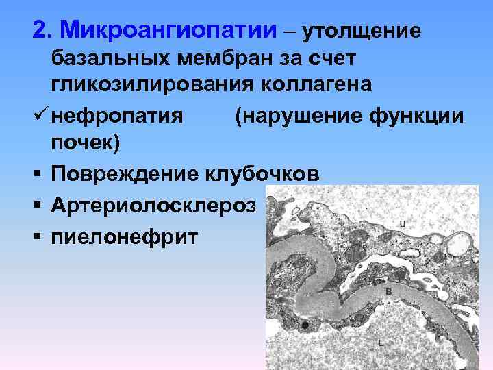 2. Микроангиопатии – утолщение базальных мембран за счет гликозилирования коллагена ü нефропатия (нарушение функции