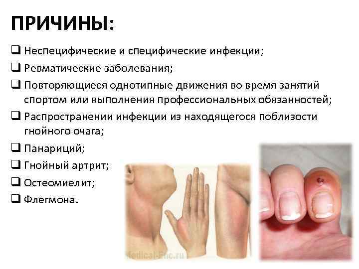 ПРИЧИНЫ: q Неспецифические инфекции; q Ревматические заболевания; q Повторяющиеся однотипные движения во время занятий