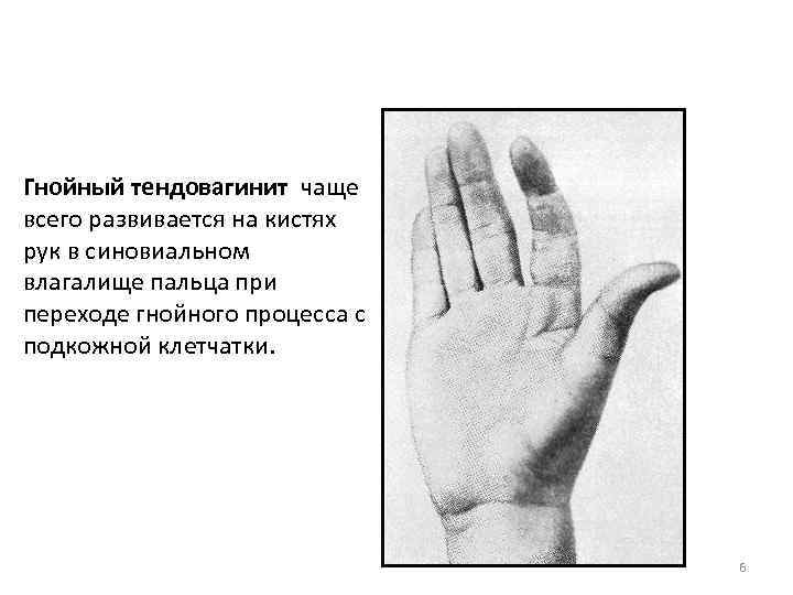 Гнойный тендовагинит чаще всего развивается на кистях рук в синовиальном влагалище пальца при переходе