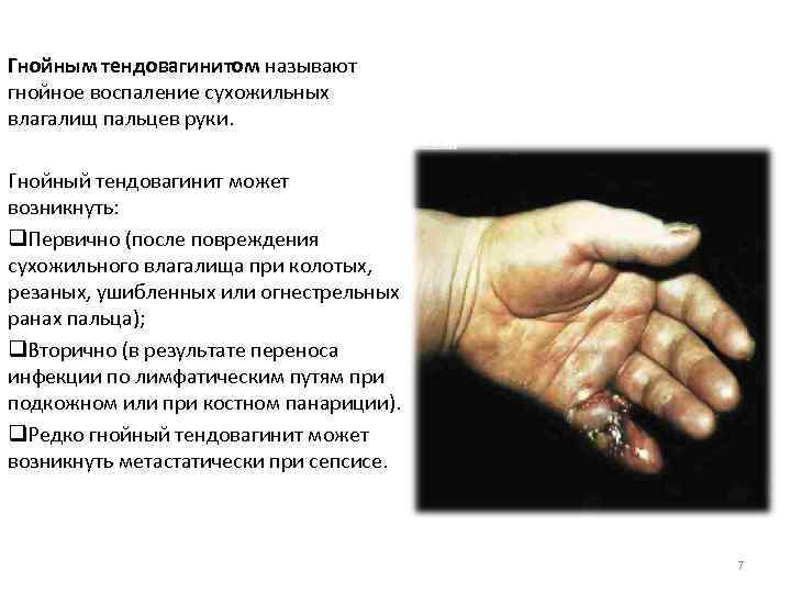 Гнойным тендовагинитом называют гнойное воспаление сухожильных влагалищ пальцев руки. Гнойный тендовагинит может возникнуть: q.