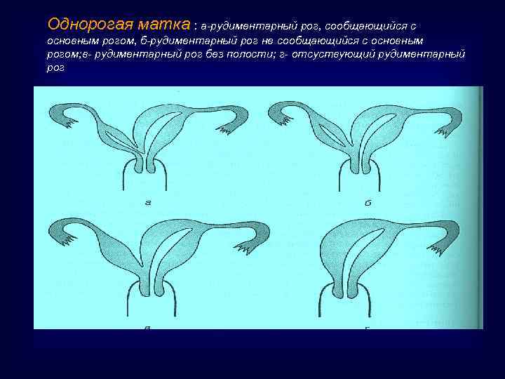 Однорогая матка : а-рудиментарный рог, сообщающийся с основным рогом, б-рудиментарный рог не сообщающийся с