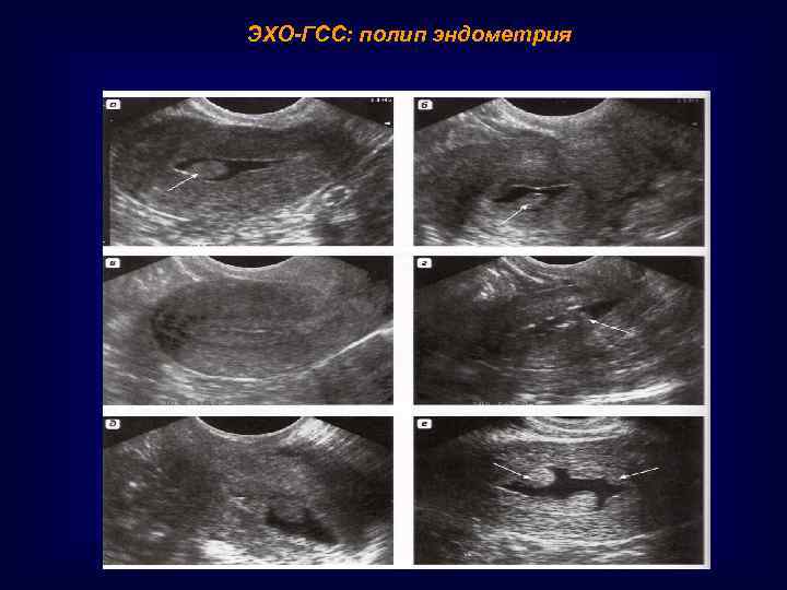ЭХО-ГСС: полип эндометрия 