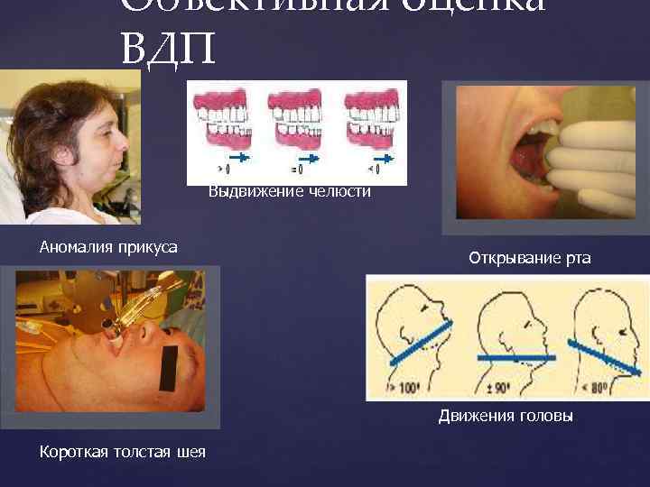 Объективная оценка ВДП Выдвижение челюсти Аномалия прикуса Открывание рта Движения головы Короткая толстая шея