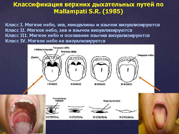 Классификация верхних дыхательных путей по Mallampati S. R. (1985) Класс I. Мягкое небо, зев,