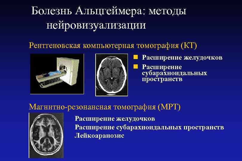 Болезнь Альцгеймера: методы нейровизуализации Рентгеновская компьютерная томография (КТ) n Расширение желудочков n Расширение субарахноидальных