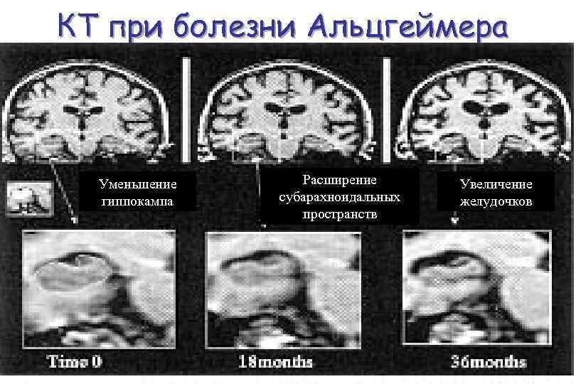 КТ при болезни Альцгеймера Уменьшение гиппокампа Расширение субарахноидальных пространств Увеличение желудочков 