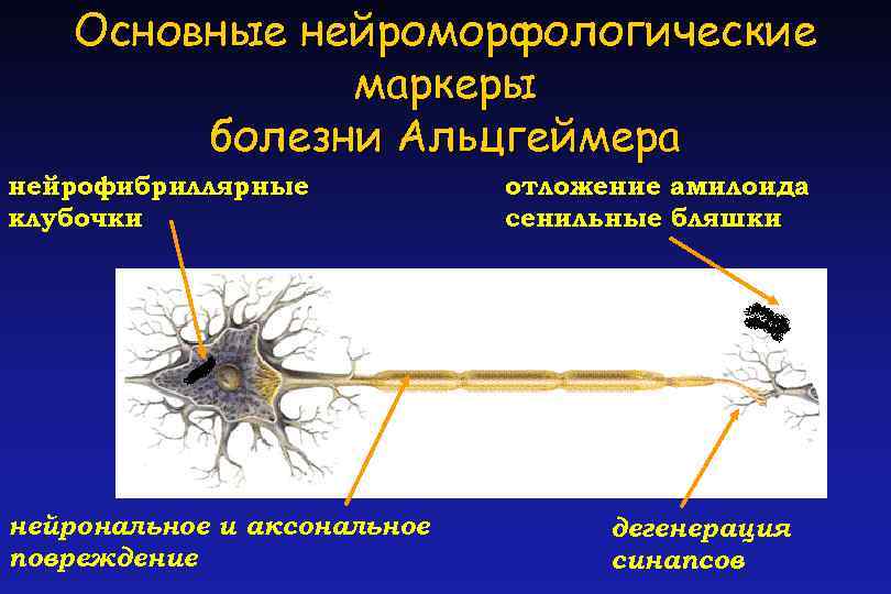Основные нейроморфологические маркеры болезни Альцгеймера нейрофибриллярные клубочки нейрональное и аксональное повреждение отложение амилоида сенильные