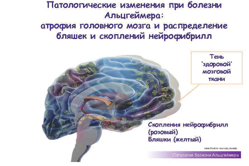 Патологические изменения при болезни Альцгеймера: атрофия головного мозга и распределение бляшек и скоплений нейрофибрилл