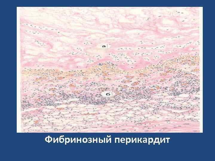 Фибринозный перикардит 