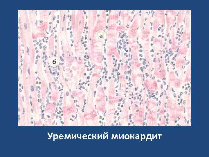 Уремический миокардит 