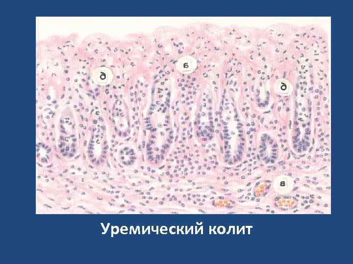 Уремический колит 