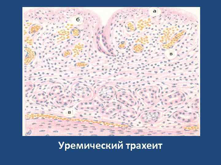 Уремический трахеит 