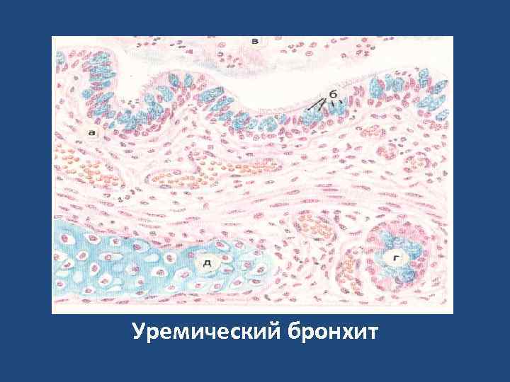 Уремический бронхит 