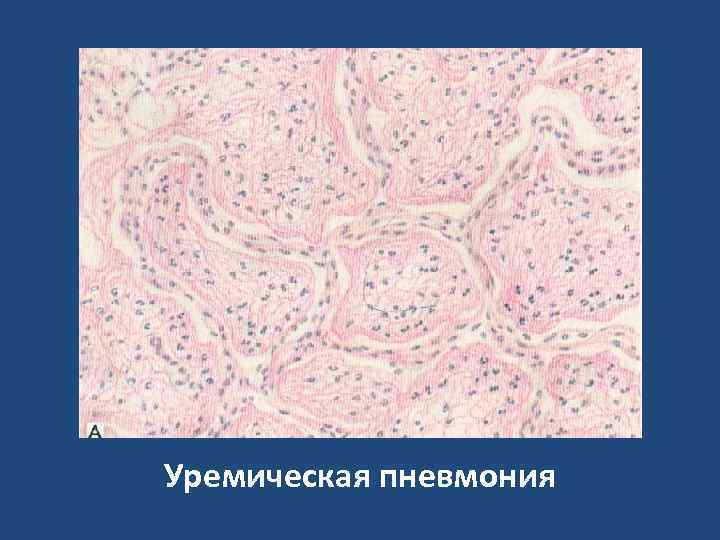 Уремическая пневмония 