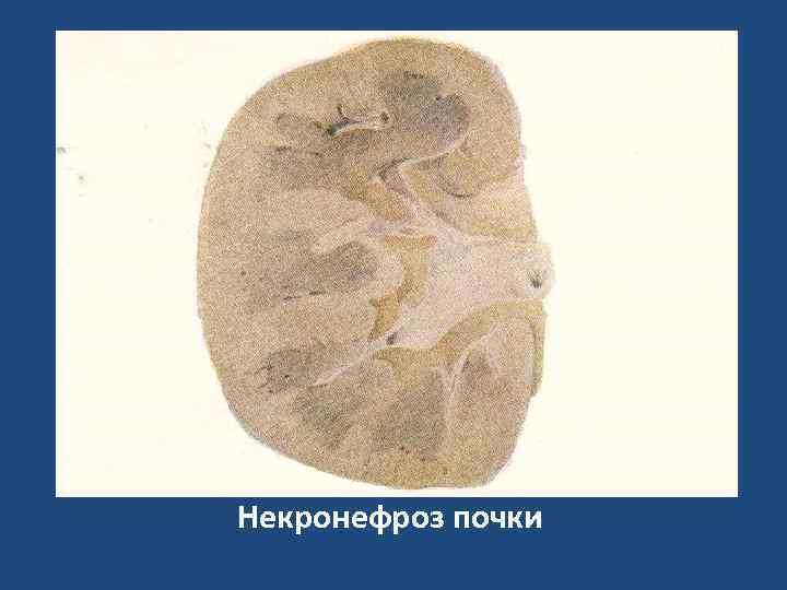 Некронефроз почки 