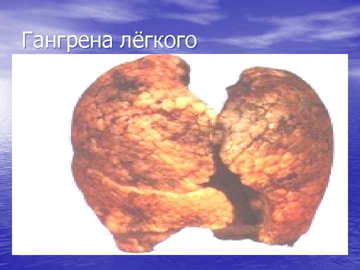 Гангрена лёгкого 