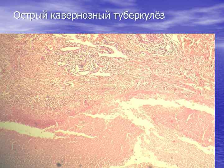 Острый кавернозный туберкулёз 