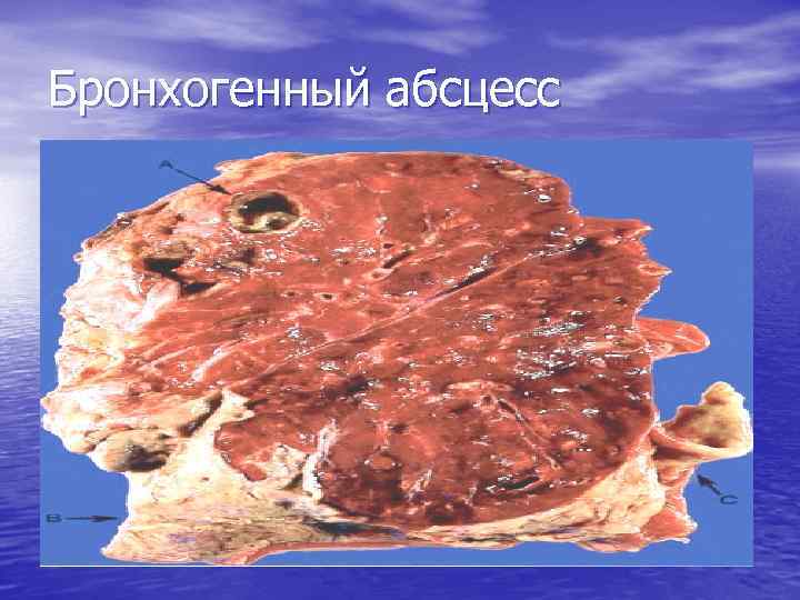 Бронхогенный абсцесс 