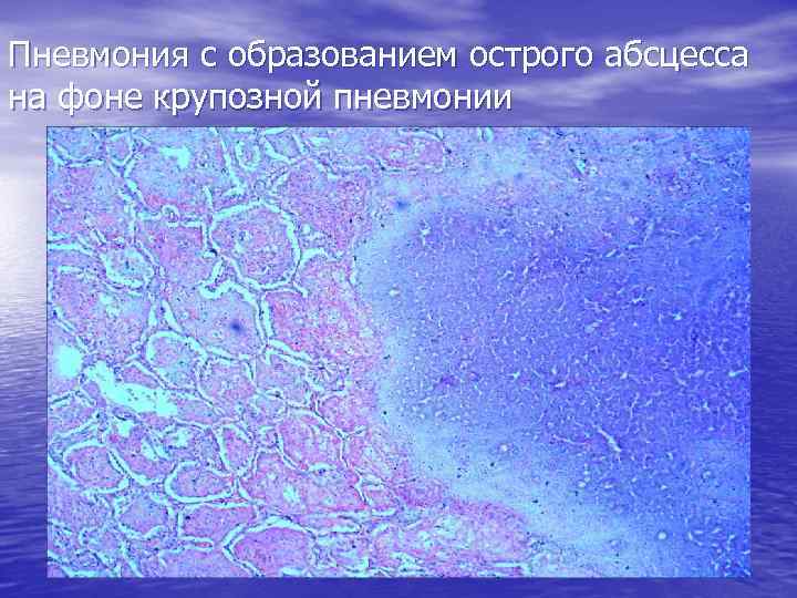Пневмония с образованием острого абсцесса на фоне крупозной пневмонии 