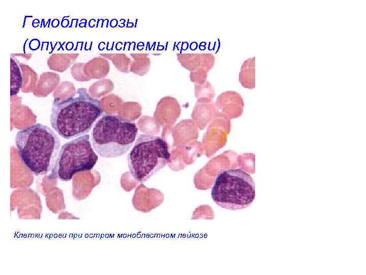 Гемобластозы (Опухоли системы крови) Клетки крови при остром монобластном лейкозе 