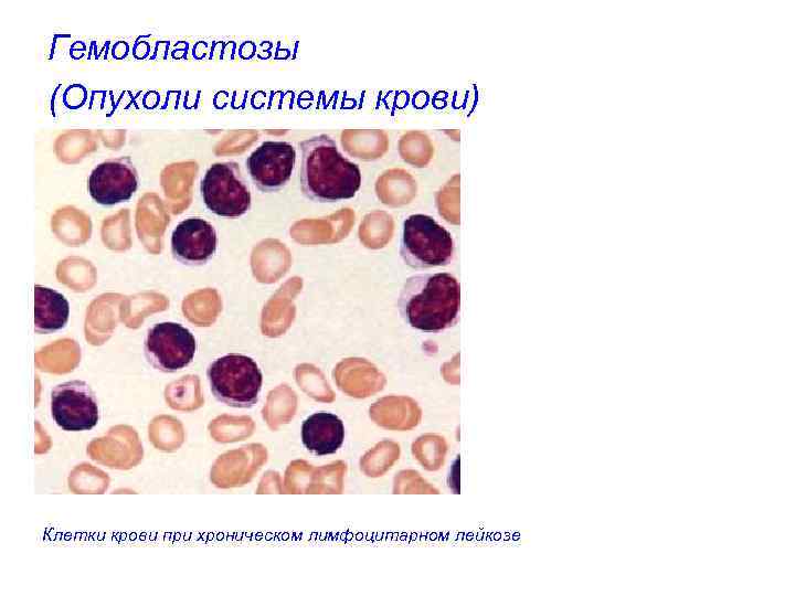 Гемобластозы (Опухоли системы крови) Клетки крови при хроническом лимфоцитарном лейкозе 
