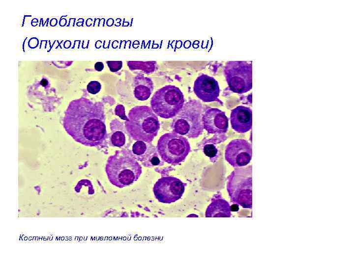 Гемобластозы (Опухоли системы крови) Костный мозг при миеломной болезни 