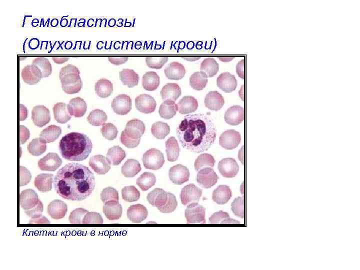 Гемобластозы (Опухоли системы крови) Клетки крови в норме 
