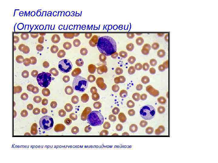 Гемобластозы (Опухоли системы крови) Клетки крови при хроническом миелоидном лейкозе 