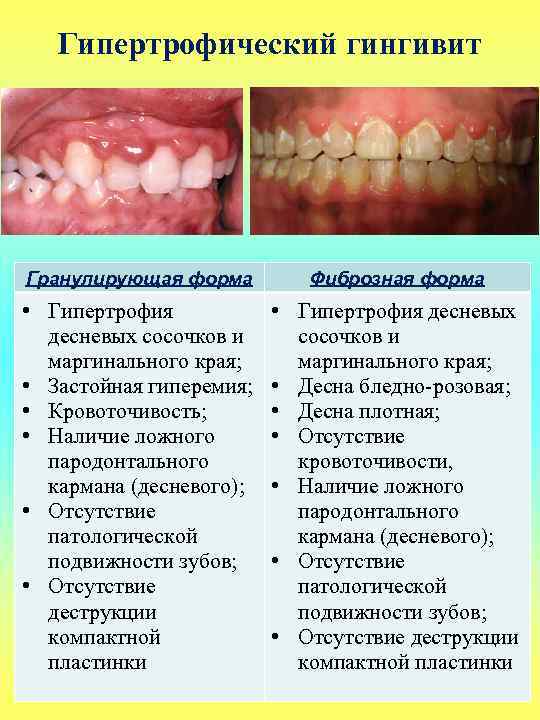 Гипертрофический гингивит Гранулирующая форма Фиброзная форма • Гипертрофия десневых сосочков и маргинального края; •