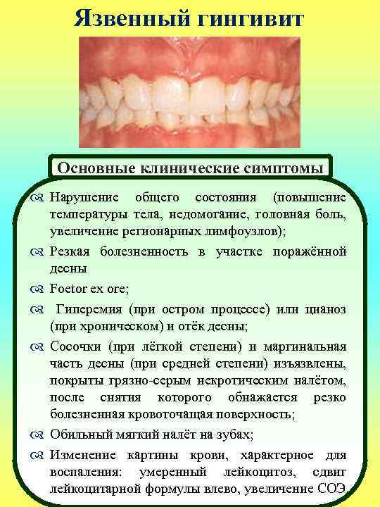 Язвенный гингивит Основные клинические симптомы Нарушение общего состояния (повышение температуры тела, недомогание, головная боль,