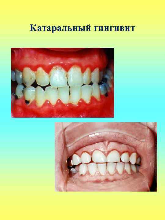 Катаральный гингивит 
