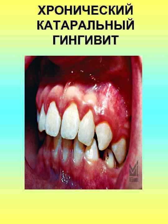 ХРОНИЧЕСКИЙ КАТАРАЛЬНЫЙ ГИНГИВИТ 