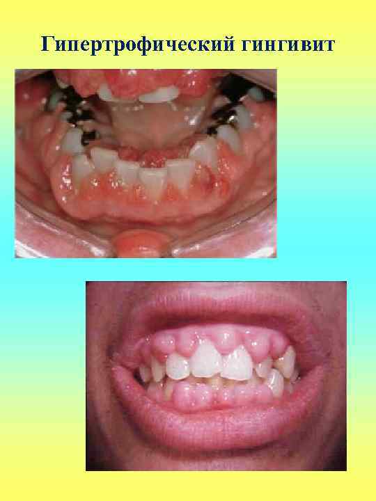 Гипертрофический гингивит 