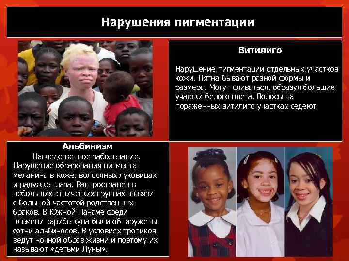 Нарушения пигментации Витилиго Нарушение пигментации отдельных участков кожи. Пятна бывают разной формы и размера.